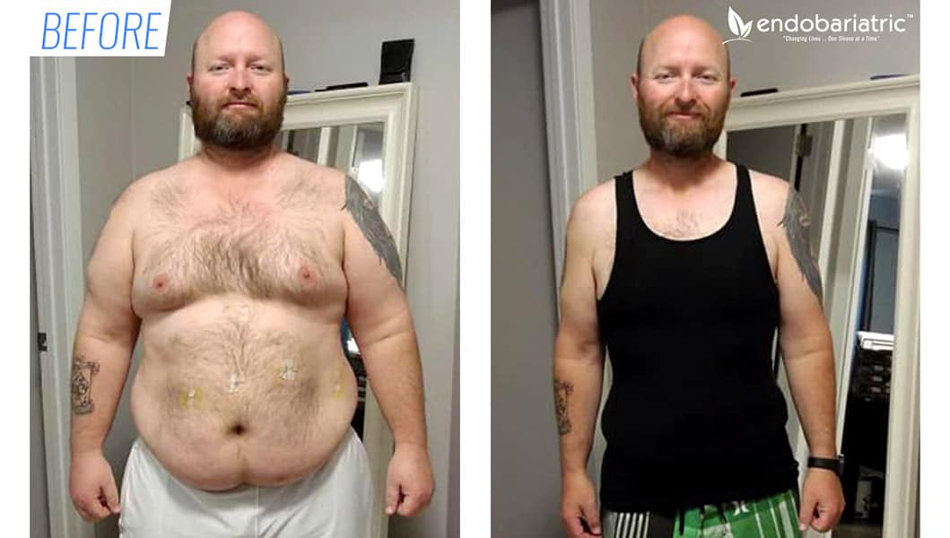 gastric bypass before and after pictures men